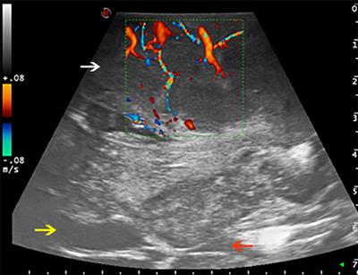 Intraoperative Ultrasound: Emerging Technology and Novel Applications in Brain Tumor Surgery